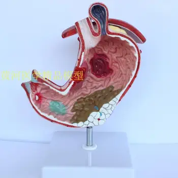 Stomacul uman anatomie model patologic model de stomac gastric patologie